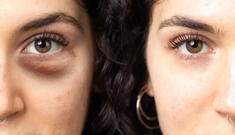 how-to-get-rid-of-dark-eyelids