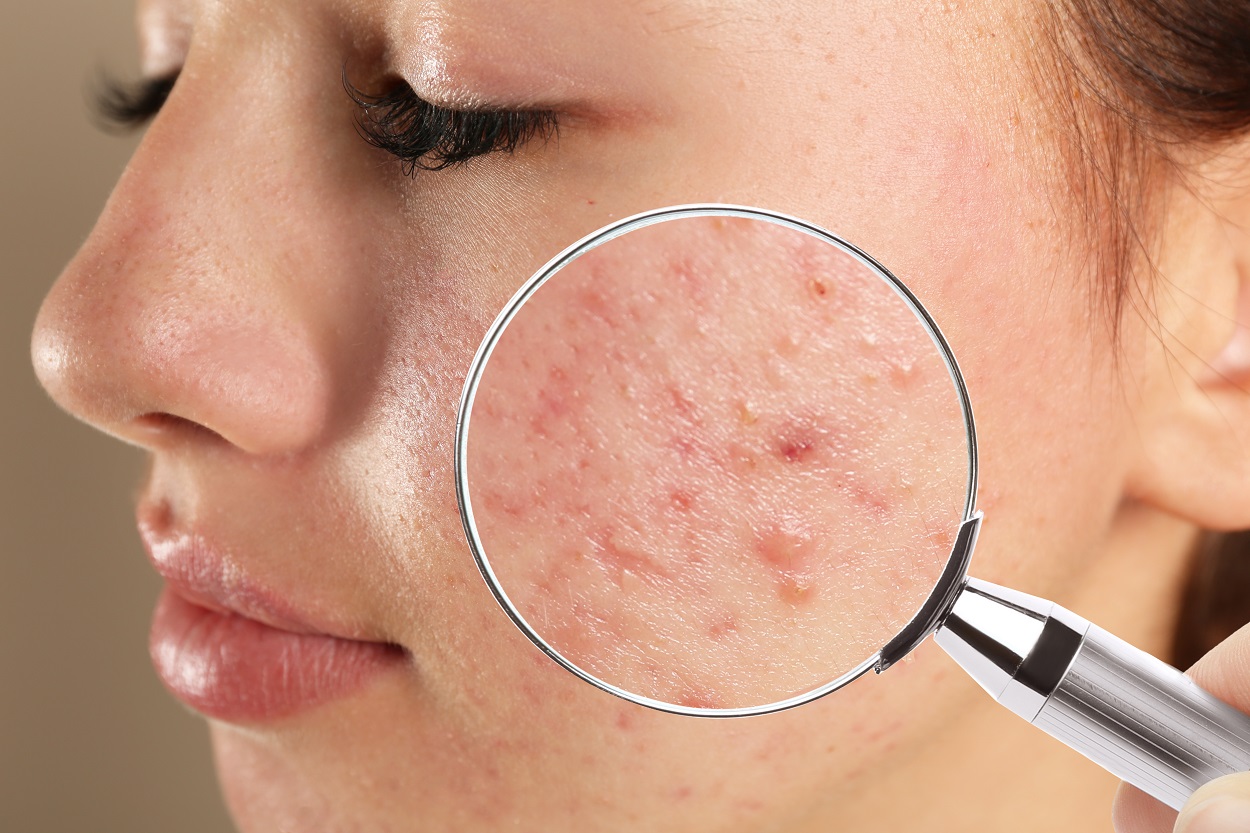How to Get Rid of Under the Skin Pimples Overnight