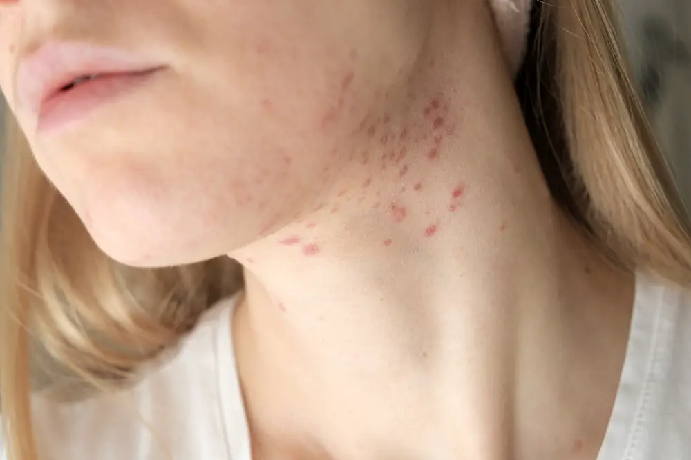 Can Hyaluronic Acid Cause Acne Exploring The Facts