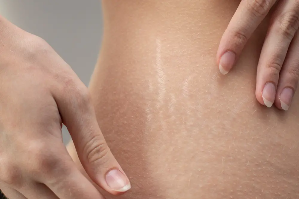 Pimples in Stretch Marks